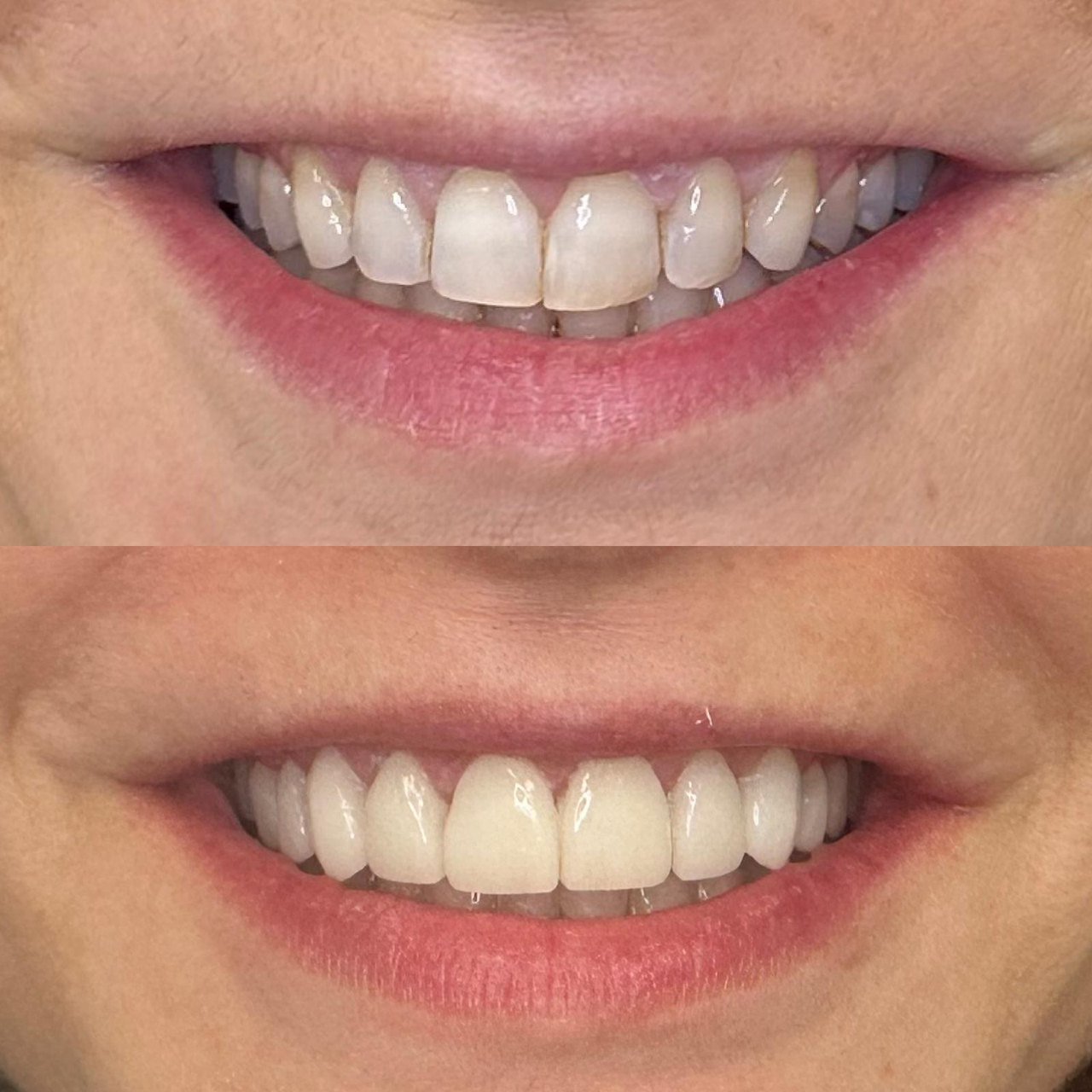 Rehabilitación estética con carillas fabricadas por Dental CN&A