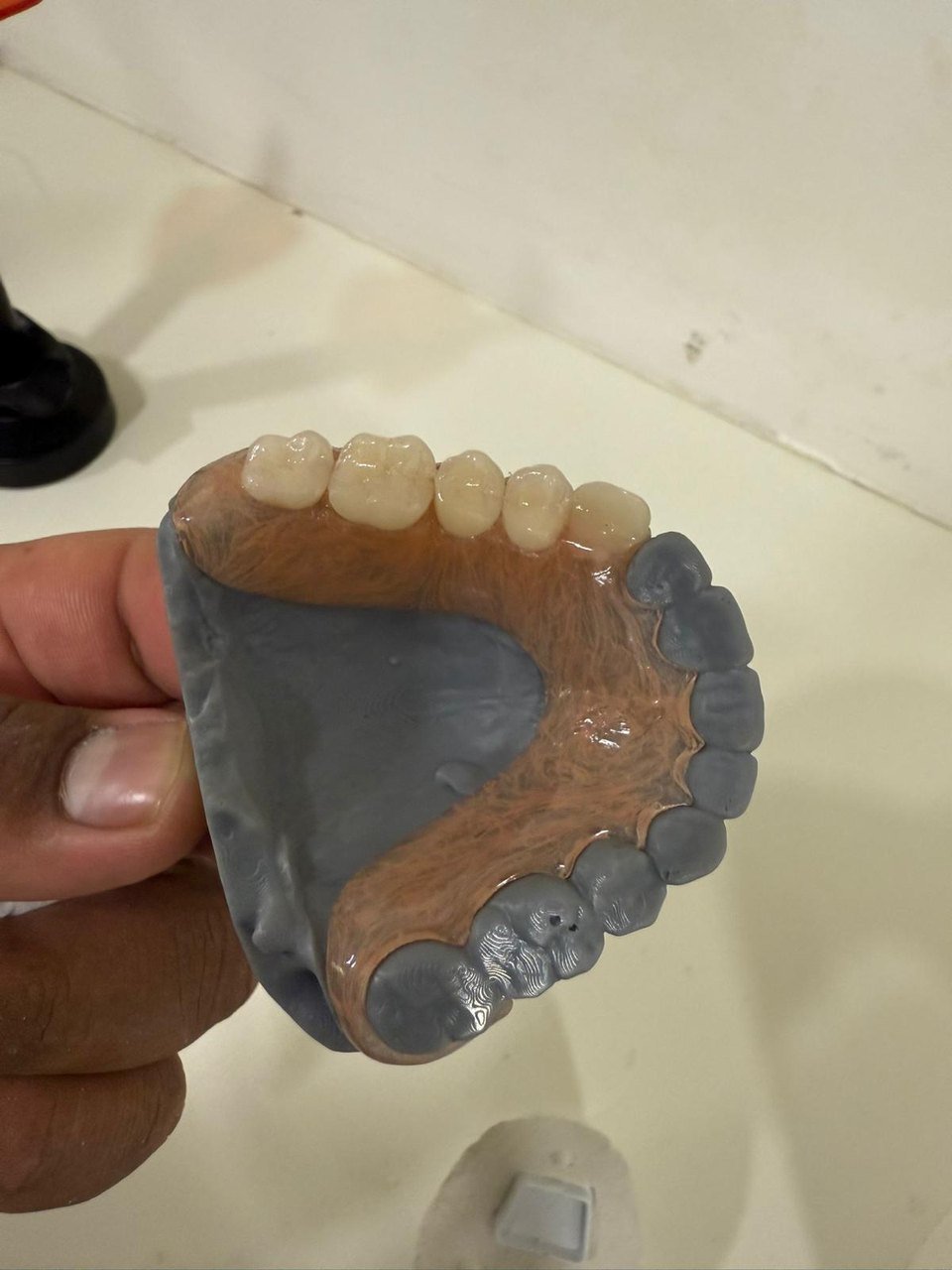 Rehabilitación completa sobre implantes