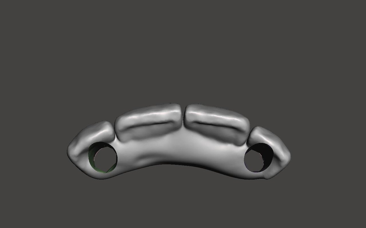 Barra sobre implantes diseñada en CAD/CAM