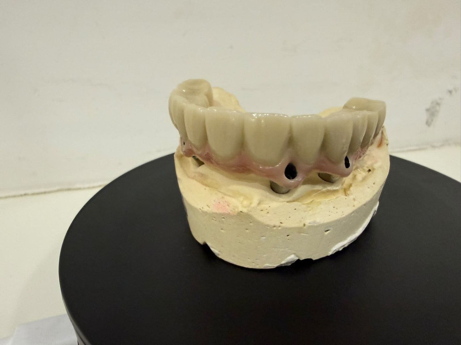 Prótesis sobre implantes fabricada en el laboratorio Dental CNA de Madrid